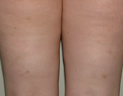 After-Mesotherapy - Cellulite