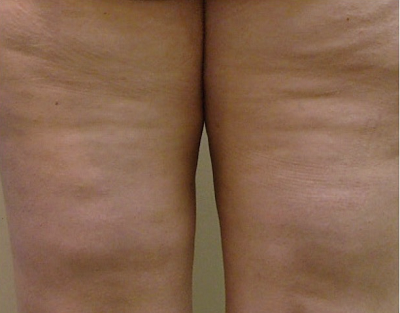 Before-Mesotherapy - Cellulite