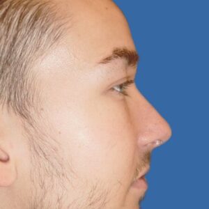 Nose-Reshaping-After