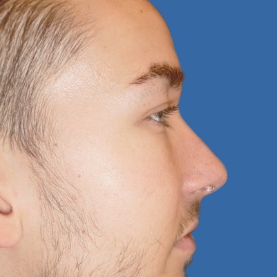 After-Nose Reshaping