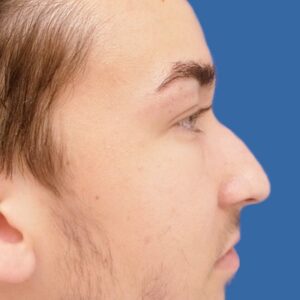 Nose-Reshaping-Before