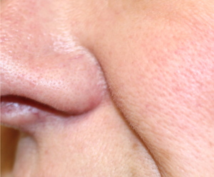 Removing-Moles-After