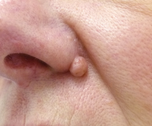 Removing-Moles-Before