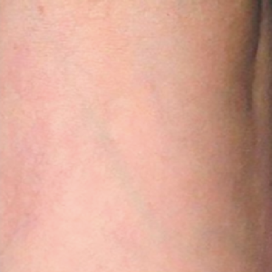 Sclerotherapy-after