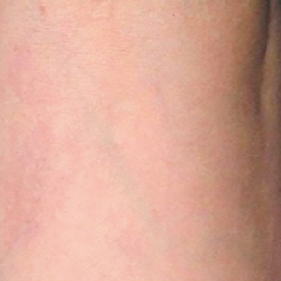 After-Sclerotherapy