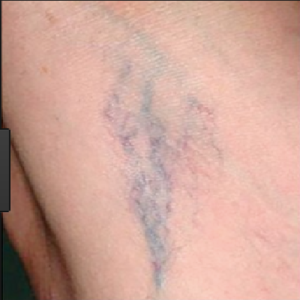 Sclerotherapy-before