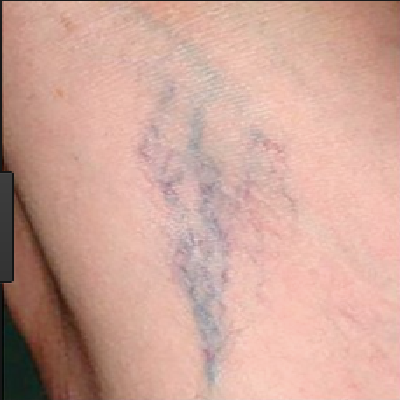 Before-Sclerotherapy