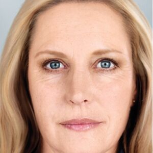Sculptra-After