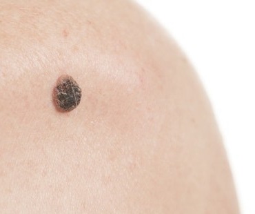 Skin-Tag-and-Moles