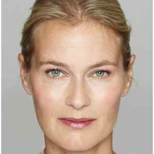 dermal-fillers-after-1
