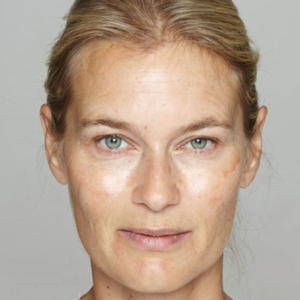dermal-fillers-before-1