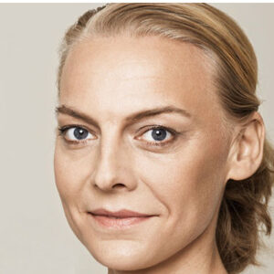 Skin Booster - Before