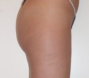 Mesotherapy-Buttocks-After