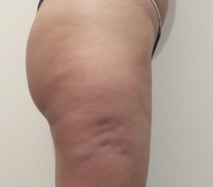Mesotherapy-Buttocks-Before