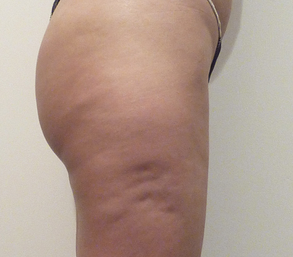 Before-Mesotherapy - Buttocks