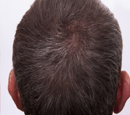 After-Mesotherapy - Hair Loss