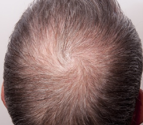 Before-Mesotherapy - Hair Loss