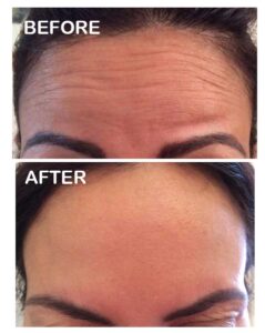 BOTOX3