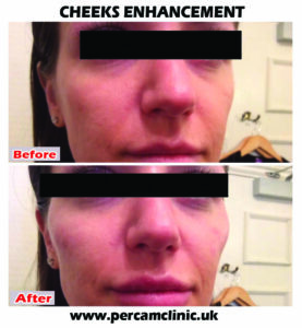 Cheek Enhancemnt