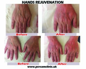 Hands Rejuvenation