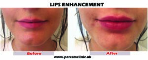 Lip 28