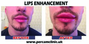 Lip12