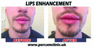 Lip13
