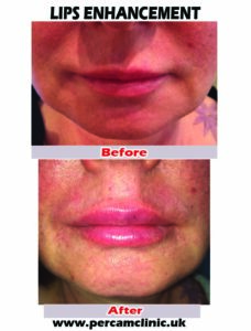 Lip14
