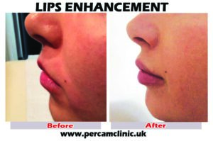 Lip15