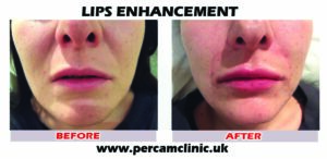 Lip16