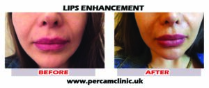 Lip17