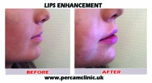 Lip18