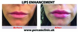 Lip19