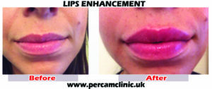 Lip22