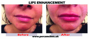 Lip26