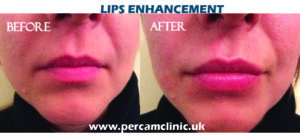 Lip27