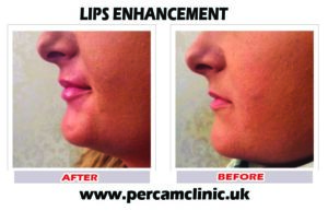 Lip34