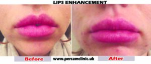 Lipsedit