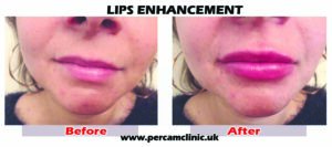 Lipweb1