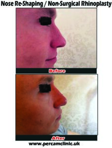 Nose 7.