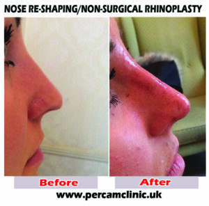 Nose12