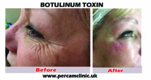 botox