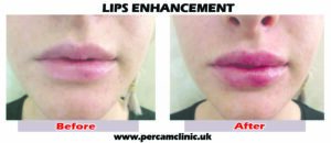 lip14 tif