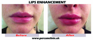 lip23 tif