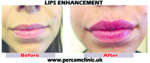 lip4